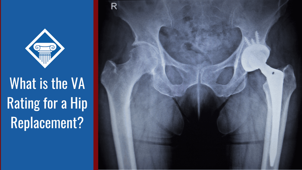 VA Disability for Hip Replacement