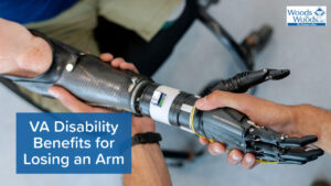 A pair of hands attaching a prosthetic arm at the elbow.