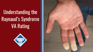 An image of a person's outstretched hand, with two finger tips turning colorless. Over the image is a red box reading the article title: Understanding the Raynaud's syndrome VA rating