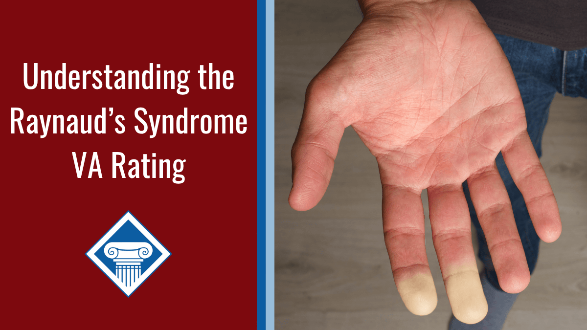 vibration white finger diagnosis What is Vibration White Finger Syndrome and How To Spot It main image 1