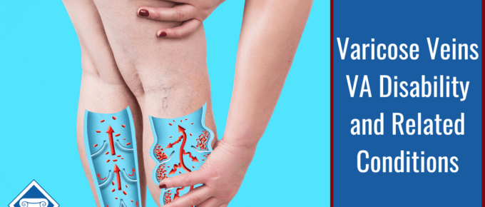 A photo with a light blue background and the bottom half of a woman's legs with her varicose veins highlighted in her calves. She is holding one leg with both hands. Article title is to the right: Varicose Veins VA Disability and Related Conditions.