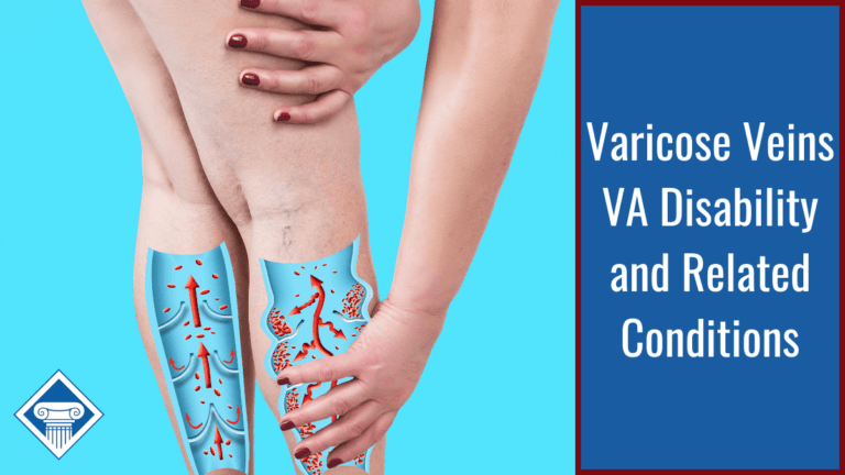 A photo with a light blue background and the bottom half of a woman's legs with her varicose veins highlighted in her calves. She is holding one leg with both hands. Article title is to the right: Varicose Veins VA Disability and Related Conditions.