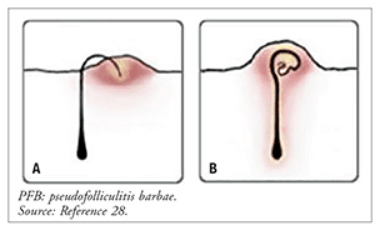 Diagram of how hairs bend over on the surface of the skin to cause a razor bump or pseudofolliculitis barbae.