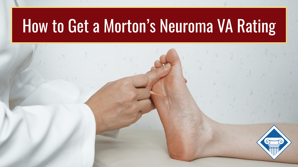 VA Rating for Morton’s Neuroma