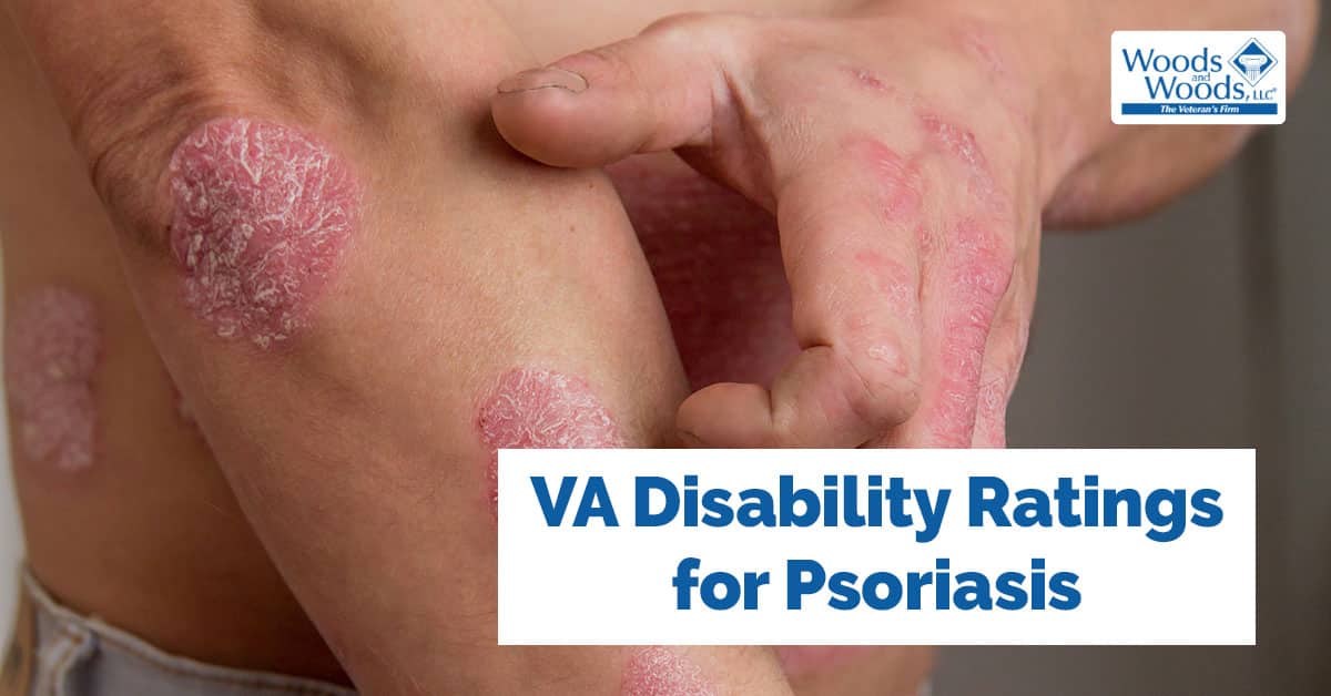 A person with their shirt off and psoriasis patches on his elbow, fingers, side, and forearm. Our title is below: VA disability ratings for Psoriasis